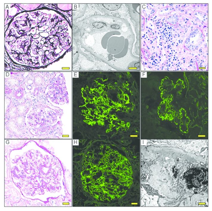 CKJsocial's tweet photo. 🆕 The histopathological spectrum of kidney biopsies in patients with #thymoma & myasthenia gravis
🆓 Access here:
https://t.co/MOjCOGjdcy
#onconephrology #tubulointerstitial #nephritis #MCD #kidney #biopsy #myastheniagravis @MyastheniaOrg @myastheniaRM https://t.co/ppOqad4y3w