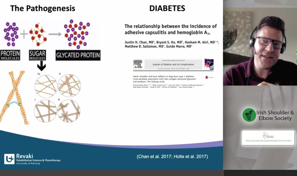 4) When protein joins with glucose in the blood, glycated haemoglobin (Haemoglobin A1c) is formed.  Haemoglobin A1c in diabetics  risk of development of Frozen Shoulder. Glycated protein is thought to play a role in collagen cross linking & development of restriction