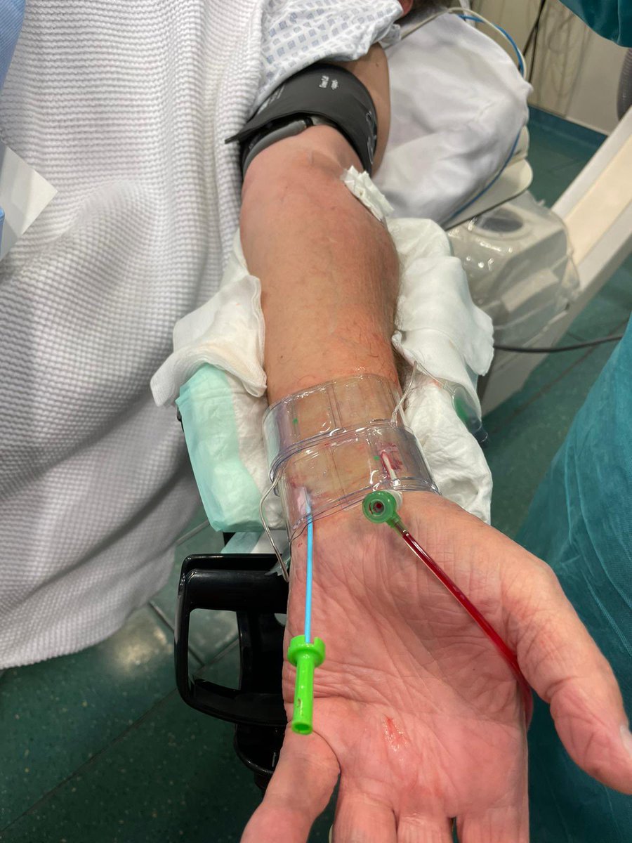 PeterGrewe3's tweet photo. #ulnarisalternativ,#cardiaccatheter
A.radialis and A.ulnaris puncture - pulse oxymetry and blood pressure cuff with sub-systolic pressure to prevent bleeding https://t.co/AAcY1uaDMc