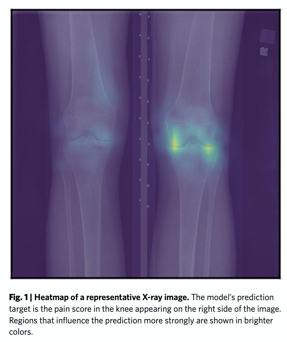 The paper details that an AI algorithm trained to use the patient’s reported pain as the outcome with which to diagnose severity of OA, rather than what the radiologist thought. It was almost *5x better* at EXPLAINING the severity of pain in black patients than radiologists....