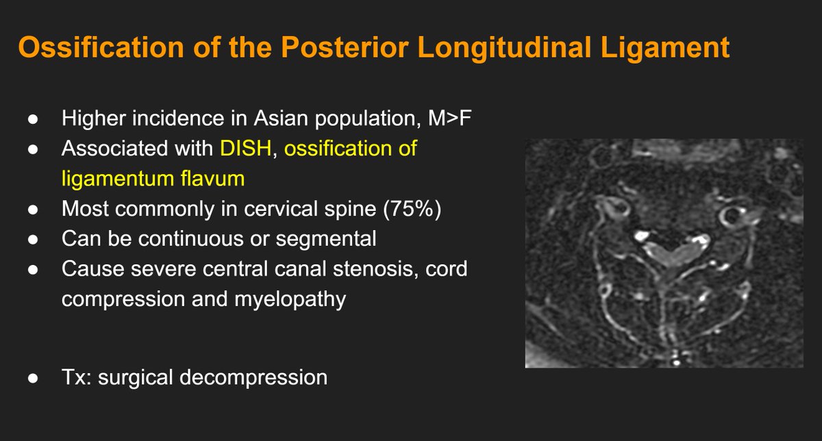 amychenvais's tweet photo. A case of OPLL! When you see a case of cervical spinal stenosis on MRI, make sure to check if there is T1/T2 dark vertical tissue in the anterior epidural space that would suggest the diagnosis. CT can be done to confirm but probably not necessary in such obvious cases! https://t.co/3WaYRMG4wR