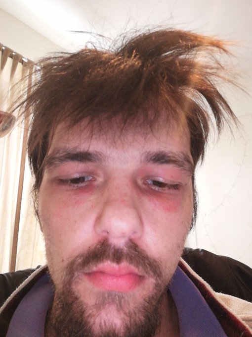 Whoo in the hospital! Liver problems and possibly covid https://t.co/MxzJFX98jH<a href="/tag/nsfwtwt"class="tags"><span>#nsfwtwt</span></a><a href="/tag/nsfwtw"class="tags"><span>#nsfwtw</span></a><a href="/tag/nsfwtwt%D9%8B%D9%8B%D9%8B%D9%8C%D9%8C%D9%8D%D9%90%D9%91"class="tags"><span>#nsfwtwtًًًٌٌٍِّ</span></a>