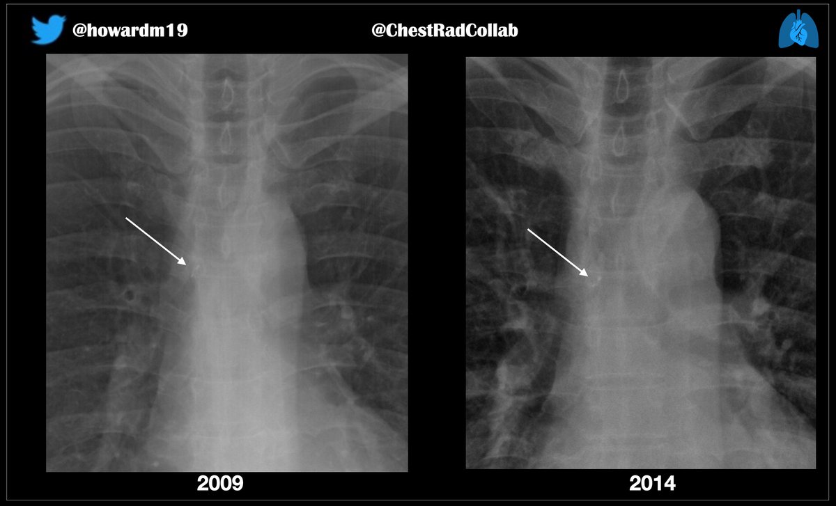 howardm19's tweet photo. @TanMohammedMD @thomasngmorris @jannimd @LucyModahlMD @JeffreyKanneMD @farouk_dako @edonnellymdphd @DarelHeitkamp @hochhegger @LeahMuhmLin @LaurenGroner @velasco_md On the dental theme: This patient reported a persistent, but not very troublesome, cough. Here are images from 2009 & 2014.
Bronchoscopy: an aspirated two-tooth denture in right main bronchus.
#ChestRadEd https://t.co/R4cpeikYEM