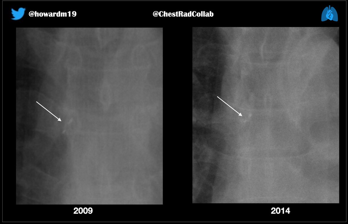 howardm19's tweet photo. @TanMohammedMD @thomasngmorris @jannimd @LucyModahlMD @JeffreyKanneMD @farouk_dako @edonnellymdphd @DarelHeitkamp @hochhegger @LeahMuhmLin @LaurenGroner @velasco_md On the dental theme: This patient reported a persistent, but not very troublesome, cough. Here are images from 2009 & 2014.
Bronchoscopy: an aspirated two-tooth denture in right main bronchus.
#ChestRadEd https://t.co/R4cpeikYEM