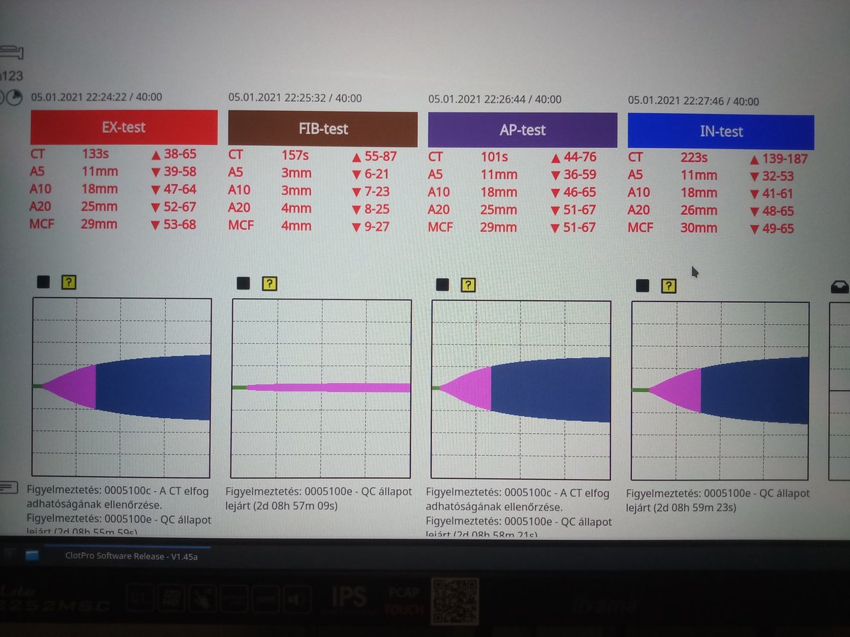 franciscojlk's tweet photo. #thromboelastometry is the graphic representation of viscoelastic changes during whole process of fibrin polymerization. Really useful in the #icu. #homeostasis #coagulation #covid19 #criticalcare #clotpro https://t.co/SOlN69DJXg