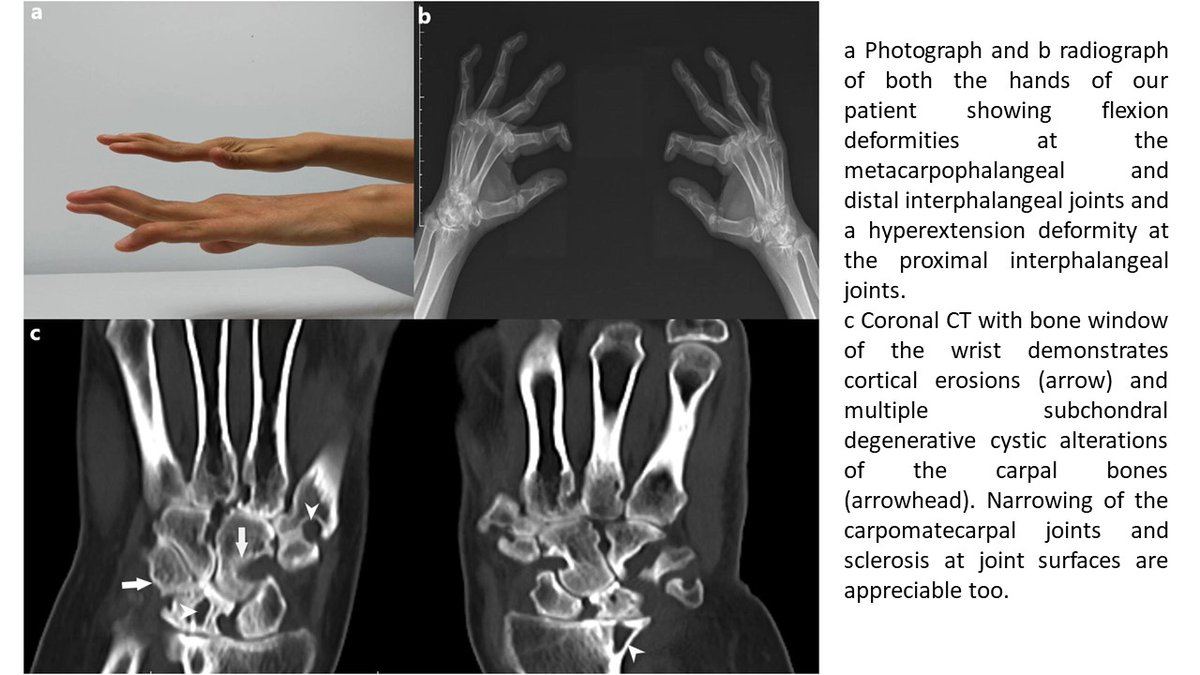 ClinRheumatol's tweet photo. A 30-year-old woman with #rhupus.
𝐖𝐡𝐚𝐭 𝐢𝐬 𝐫𝐞𝐬𝐩𝐨𝐧𝐬𝐢𝐛𝐥𝐞 𝐟𝐨𝐫 𝐭𝐡𝐢𝐬 𝐚𝐩𝐩𝐞𝐚𝐫𝐚𝐧𝐜𝐞?
𝐀𝐧𝐬𝐰𝐞𝐫👉 https://t.co/bREsihLi7E
#FOAMrad #FOAMed #RheumTwitter https://t.co/4NnVInq862