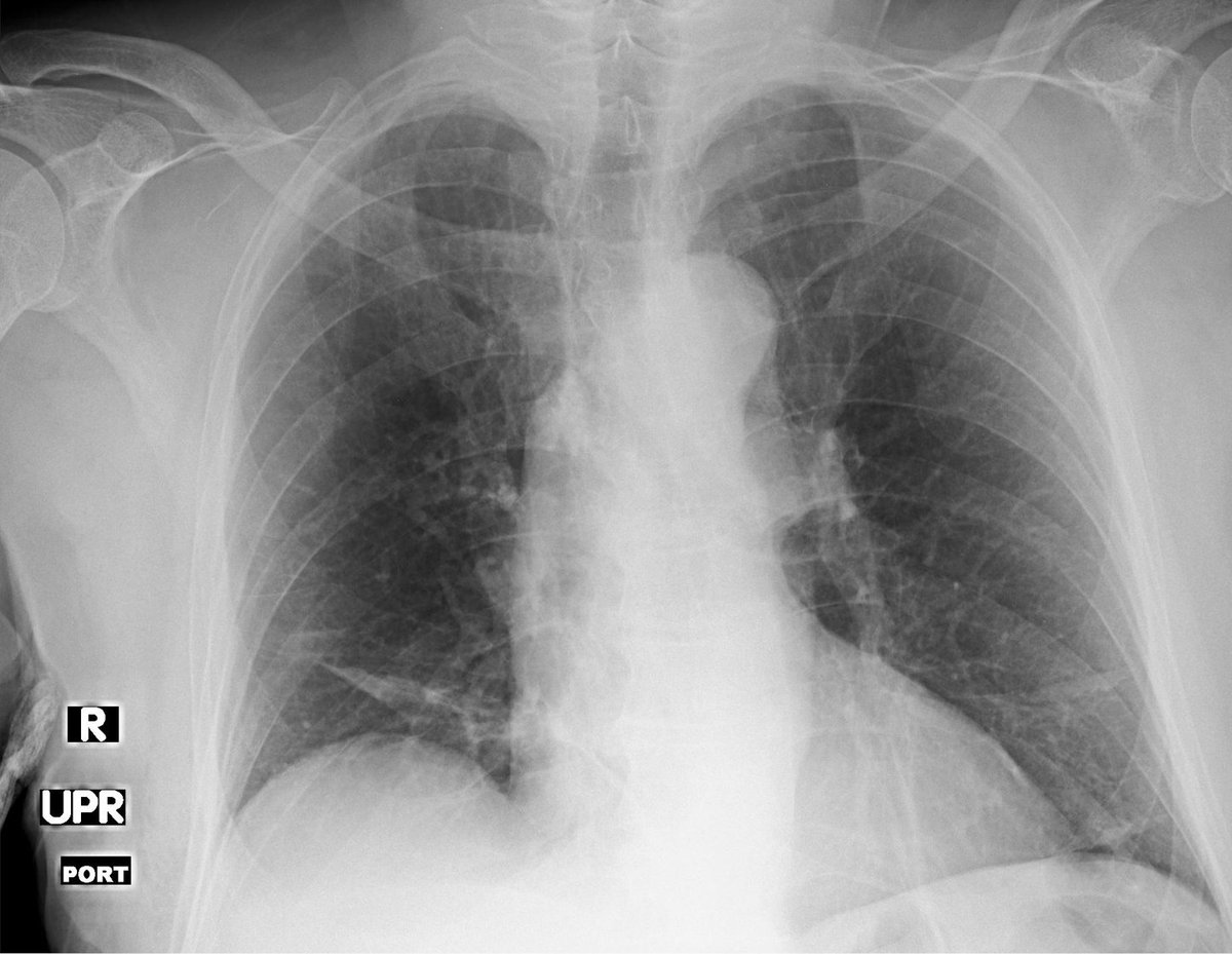 jannimd's tweet photo. What's the injury?
Hx: MVA
Hint: it's outside the chest
Answer: R scapula fracture
#ChestRadEd @ACER_AUR @theAPDR @ASER_ERAD @StefanTigges @Radiology911 @skeletalrad @EZERads @JanFritzMSK @TanMohammedMD @AwanRad @gargtushark @koolkpMD @AminaFarooqMD @francisdeng https://t.co/ssaWVbTLPW