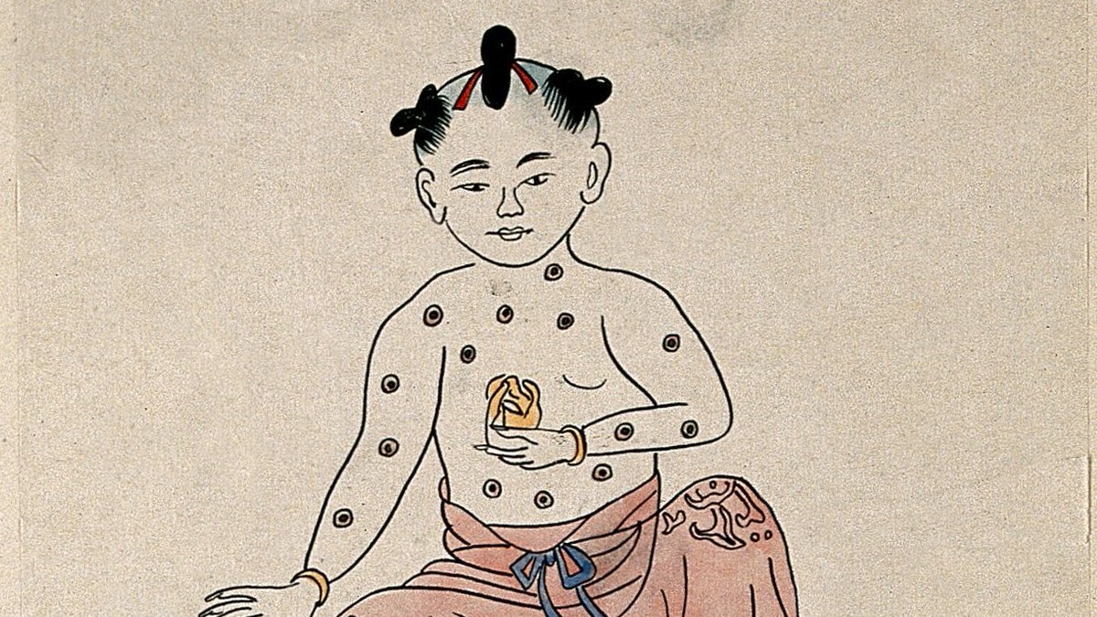 This was widespread, including in Africa, China, India and Turkey, and practised in different ways according to local custom (including inhalation of powdered dried smallpox scabs and scratching fluid from a smallpox lesion onto the skin)...  3/12 (Image  @ExploreWellcome CC-BY)