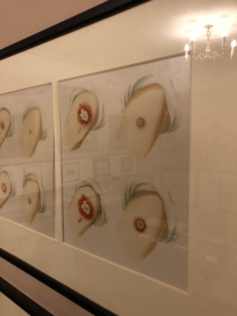 Vaccination was different. It relied on infection with an animal virus, cowpox, to produce immunity against smallpox. Cowpox in humans was significantly safer and, crucially, it allowed for the chains of transmission of the smallpox virus to be broken...  9/12