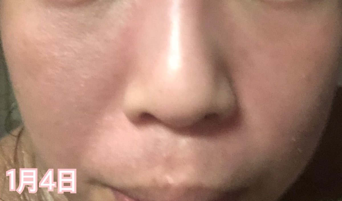 るいちゃん على تويتر 大した変化もなくパサパサと乾燥して赤みも健在 鼻に赤いポツポツが出現している 頬の保湿をやめたことで頬と小鼻の横が 皮むけするようになった 鼻の下もすごく悪くはないけどパサパサとまた少し小さめの鱗屑が付くようになった 一進一退