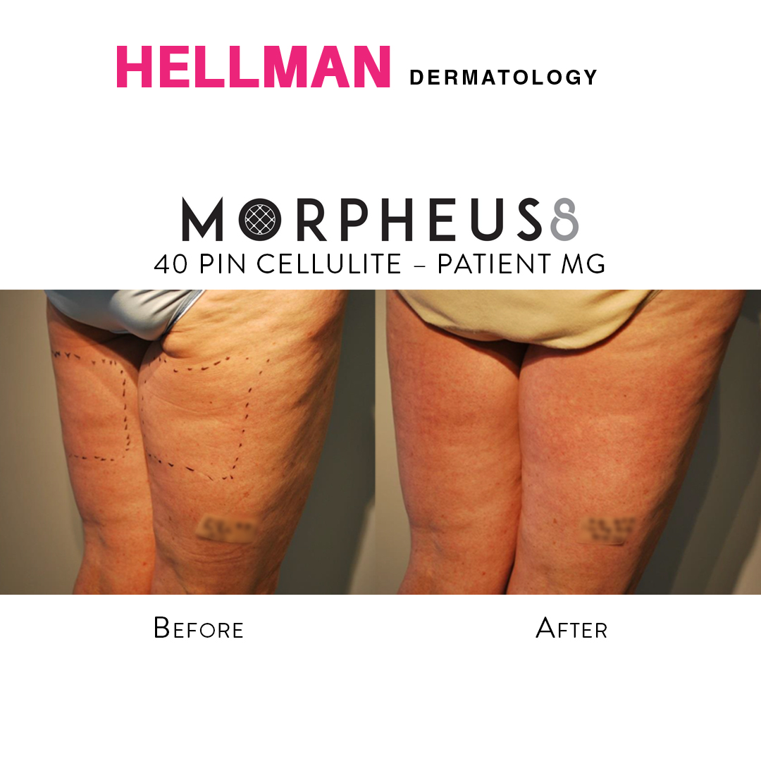 Dr. Hellman uses Morpheus8 RF technology to reduce cellulite. Look at these before and after photos of a recent patient.

#celluliteremoval #morpheus8 #inmode #cellulitis #cellulite #cellulitetreatment #cellulitereduction #beforeandafter #cosmetictreatments #dermatologistnyc