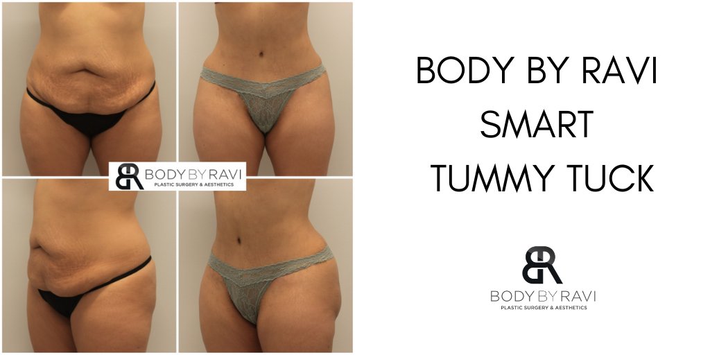 Dr. Ravi Somayazula on X: Are you looking for a flat stomach, snatched  waistline, and cute little belly button? Dr. Ravi's SMART Tummy Tuck uses  cutting-edge surgical techniques to remove excess skin