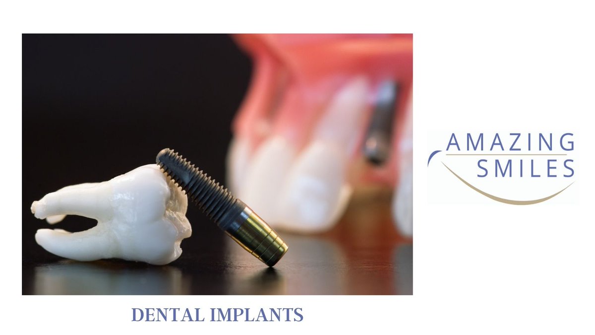 JandaliDMD's tweet photo. Dental implants have become the viable treatment option to replace missing teeth and are now referred to as the “standard of care” for replacing missing or failing teeth.

#dentalimplants #dentistry #DigitalDentistry #SmileDesign #SameDayTeeth #dentist #dental #implants https://t.co/AYaHt8S7G7