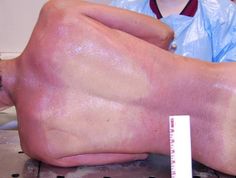 Livor mortis: - the pooling of the blood in the body due to gravity and the lack of blood circulation as a result of decreased cardiac activity- absent in compressed vessels - starts 1/2 min to 2 h and max. 12 h after death (1/3)