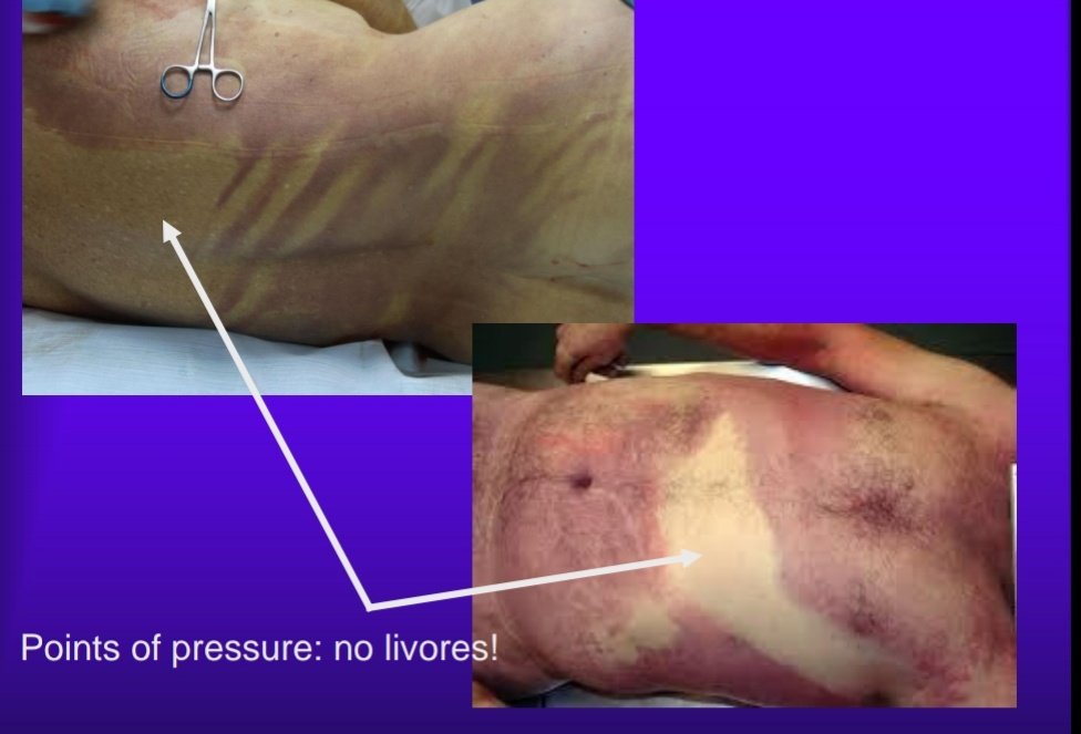 (3/3)Points of pressure "compressed vessels" = no livor mortis