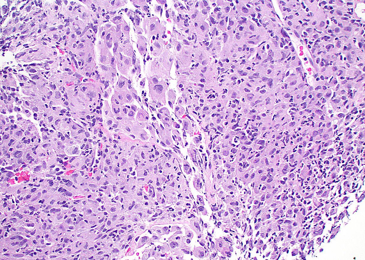 Pleomorphic cells with abundant pink cytoplasm in a lymph node #FNA, h/o follicular lymphoma. CD163 stain bottom left. Positive for clonal IgH rearrangement. S/O'ed as 'Malignant histiocytic neoplasm c/w histiocytic transformation of follicular lymphoma.' #cytology #cytopath