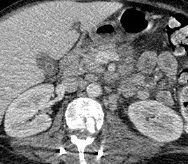 JoseLuisdelCura's tweet photo. Tratamiento percutáneo de pseudoaneurisma de arteria esplénica. Inyección de trombina guiada por eco del seudoaneurisma con trombosis del mismo que se mantiene en un control al cabo de unos meses.
Una excelente alternativa al procedimiento endovascular. Más rápido y sencillo. https://t.co/zv4WAQQW8I