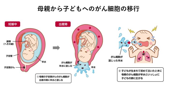 TakashiKohno2's tweet photo. 母親の子宮頸がんが出産時に子供の肺に移ってしまうという現象をNEJM誌に発表しました。小児科ドクターの鋭い眼による発見です。がん遺伝子パネル検査が普及すると、医療現場で新しいことが見つかるのだと再認識。https://t.co/0SKm8GNYWd https://t.co/vuotIuCNGH