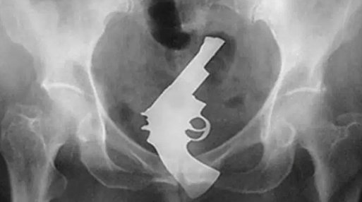 お尻に異物を入れた患者のレントゲン写真はたまにアルバムジャケットにしたいぐらいカッコイイ構図の奴があるから困る Togetter