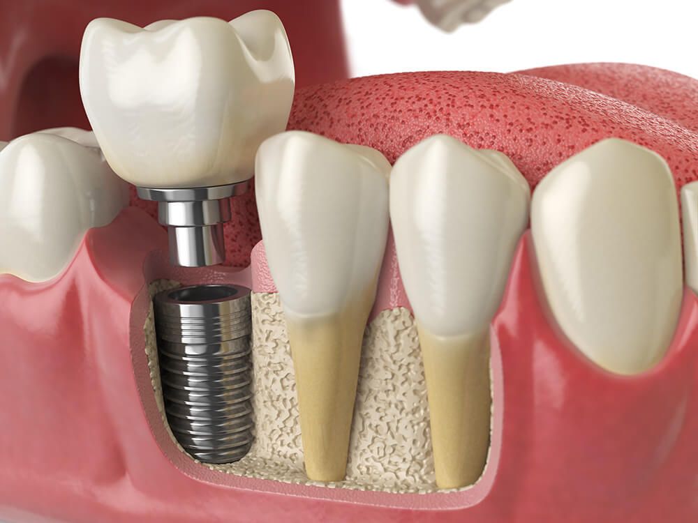 Dental Bridge, Prosthesis Or Implant – THE BEST OPTION FOR YOU: buff.ly/391SxKl
