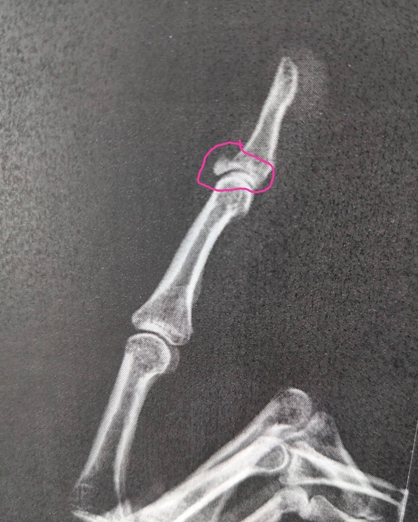 A final gift from 2020 delivered my car door slamming shut. That circled bit is where the tendon attaches to the bone. 
Also very appropriately it's my middle finger🖕🏼Happy New Year!