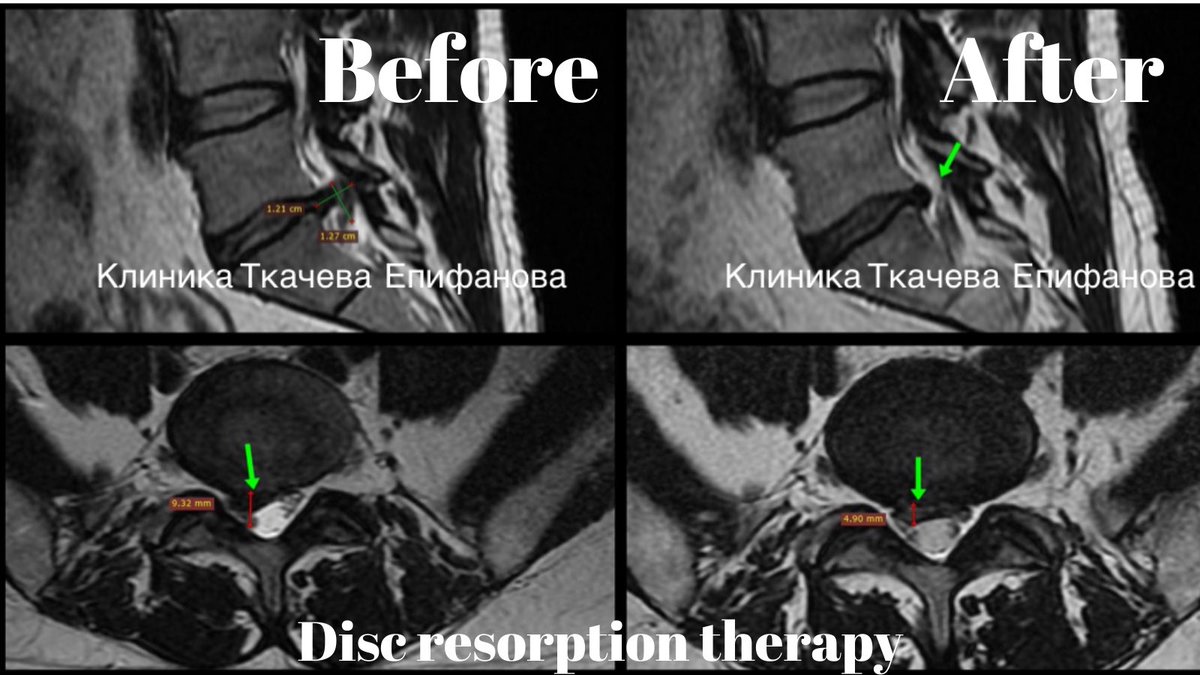 AlexanderTkac11's tweet photo. The goal of our treatment is to stimulate herniated disc resorption and healing. #backpain #spine #discresorption https://t.co/SKwgcixSfs