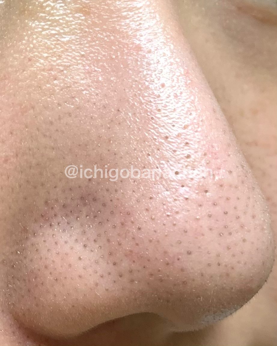 いちご鼻と戦うちゃん Ichigobanachan Twitter