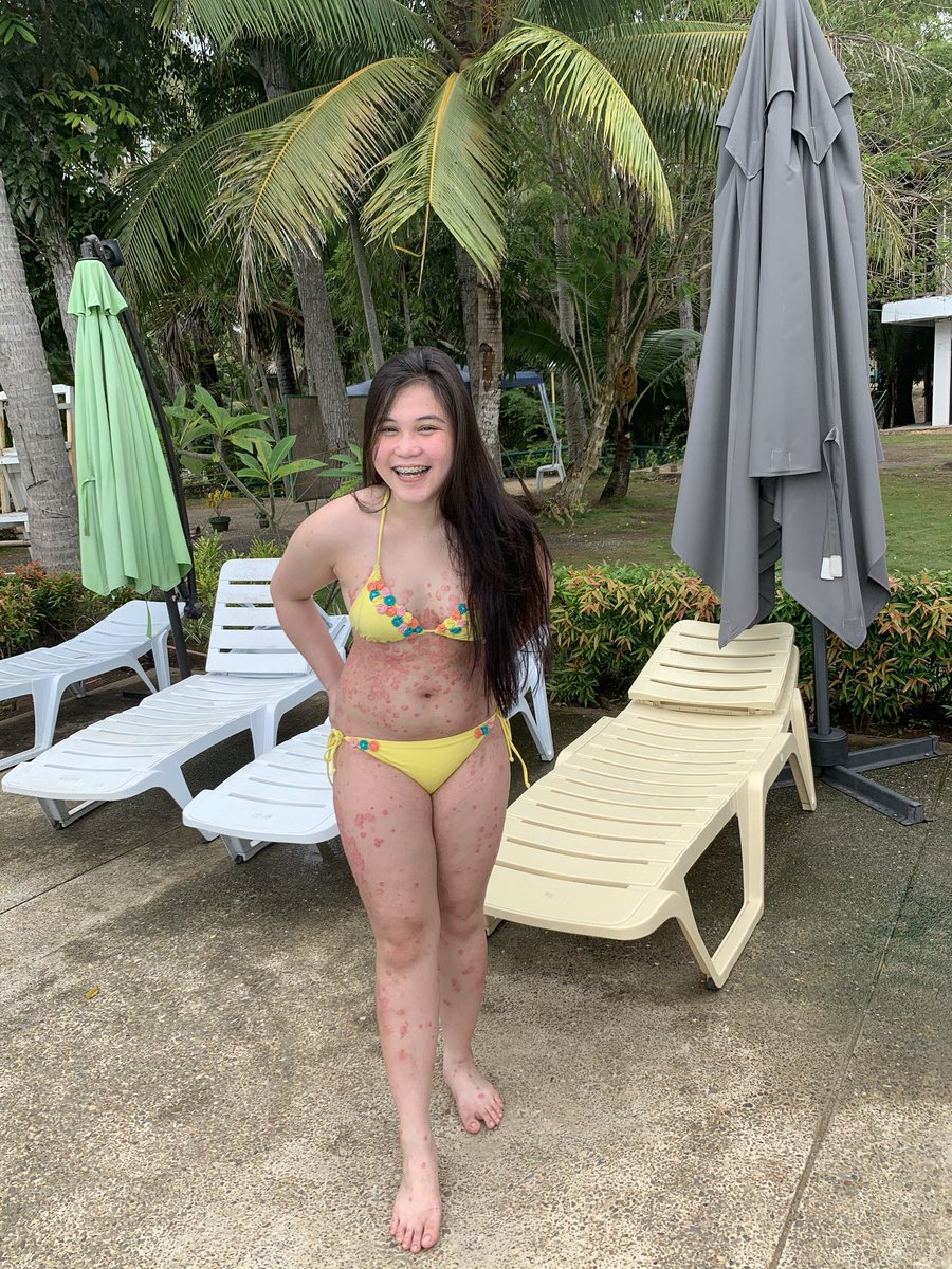 mapascarlett's tweet photo. When you accept your flaws, no one can use them against you. ☀️

I'm Scarlett Mapa. I have Psoriasis.. but Psoriasis doesn't have me. #psoriasiswarrior https://t.co/K1wj1mLcFl