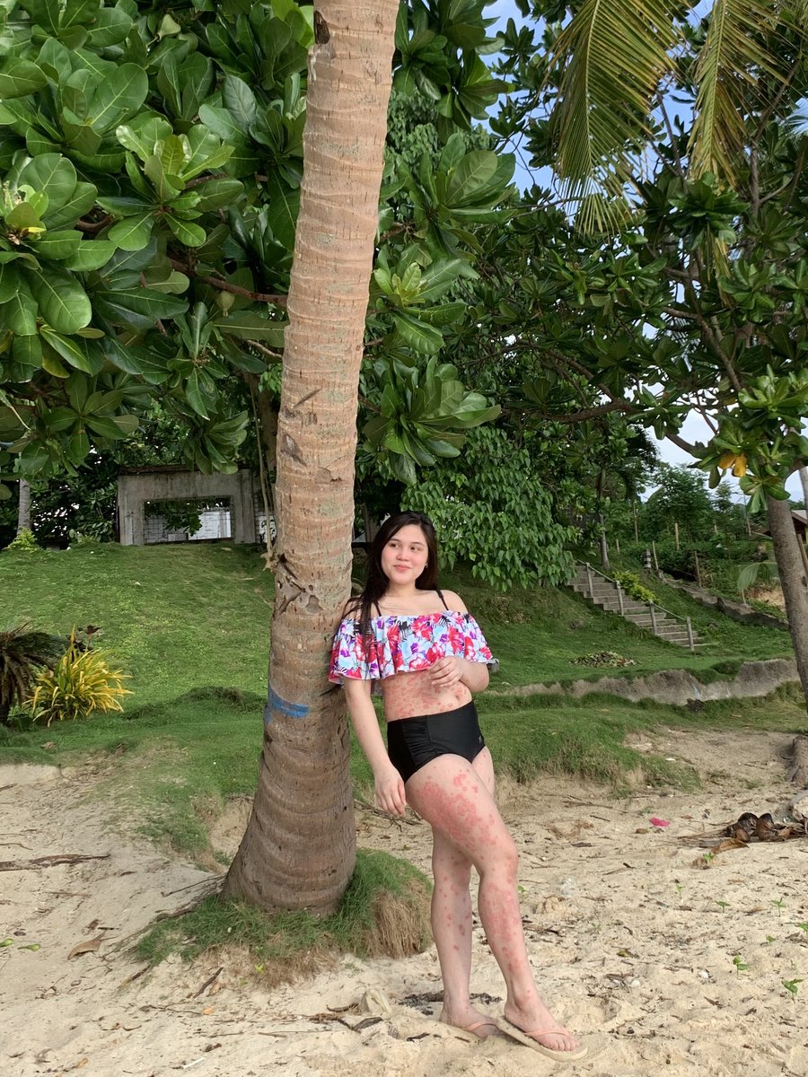 mapascarlett's tweet photo. When you accept your flaws, no one can use them against you. ☀️

I'm Scarlett Mapa. I have Psoriasis.. but Psoriasis doesn't have me. #psoriasiswarrior https://t.co/K1wj1mLcFl
