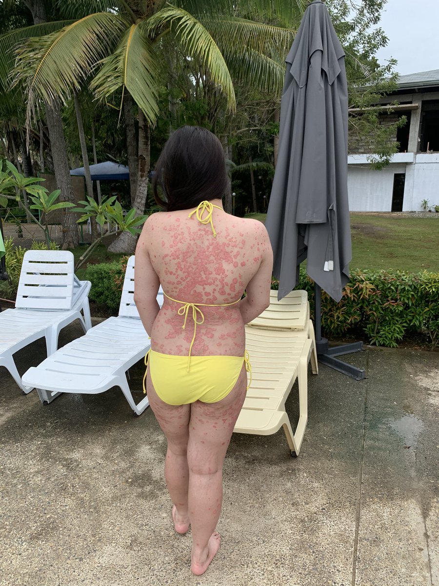 mapascarlett's tweet photo. When you accept your flaws, no one can use them against you. ☀️

I'm Scarlett Mapa. I have Psoriasis.. but Psoriasis doesn't have me. #psoriasiswarrior https://t.co/K1wj1mLcFl