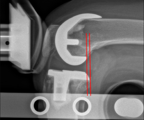 "If more studies using clever and effective experimental designs like the one by Kim et al in #JBJS are conducted, we'll have robust assessments of the incremental impact of prosthetic design on clinical outcomes," says Editor-in-Chief <a href="/swion001/">Marc Swiontkowski,MD</a>. bit.jbjs.org/3990wW1