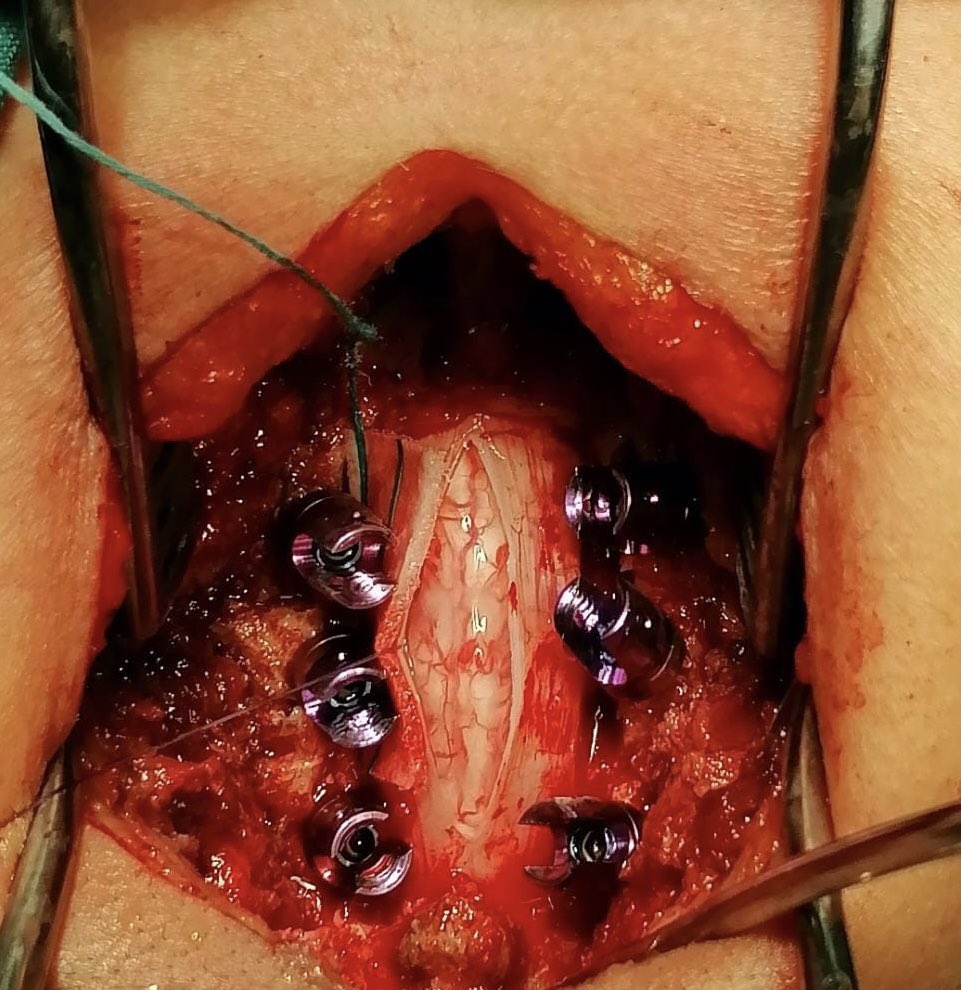 Invimedic's tweet photo. Laminectomía, exéresis de lesión tumoral y artrodesis cervical posterior cerebral
👨🏻‍⚕️Dr. Arturo Álvarez
🏨 Hospital Teodoro Maldonado Carbo
.
.
#Laminectomia #artrodesis #columna #spine #Invimedic #exeresis #tumor #HTMC https://t.co/4EkhoWAbve