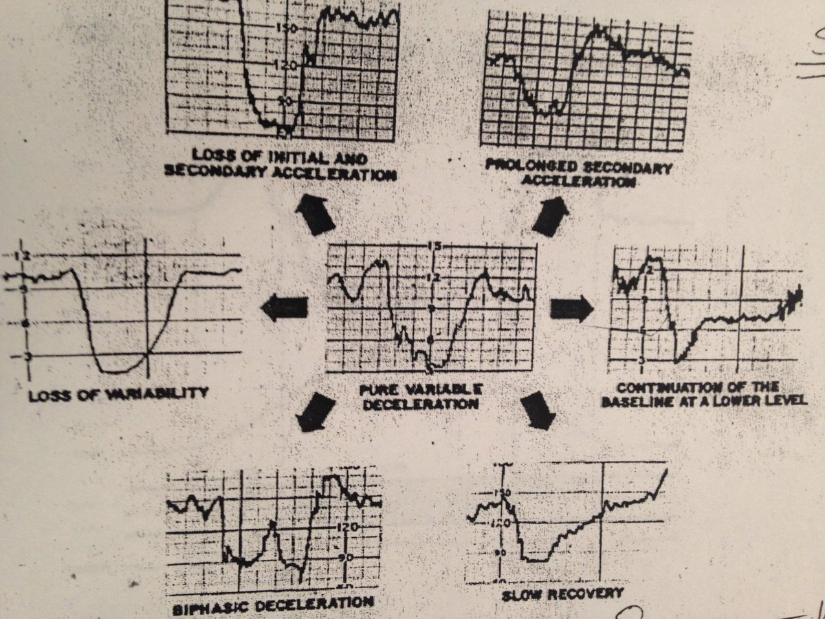 jcollinsmd77's tweet photo. OB Facts: Common cord compression patterns - do not go home if you notice one of these patterns. Demand an U/S to review the cord location. https://t.co/mx39vI11jE
