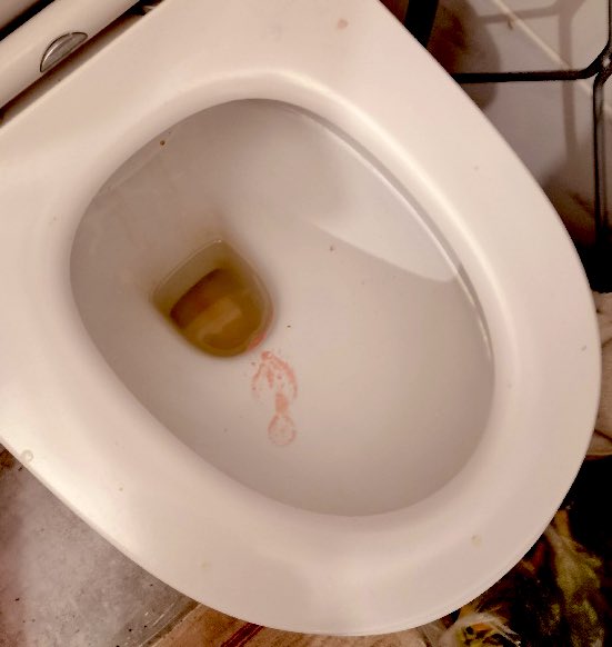 maxgau1's tweet photo. #LTSMUR 

Détresse respiratoire à domicile chez patient de 88 ans 
L’ambulancier a fait le diagnostic en entrant dans les toilettes du patient. 

Mais quel diagnostic ? 

(Il s’agit d’un crachat et désolé pour le côté glauque de cette iconographie) https://t.co/9dhBHP4ALT