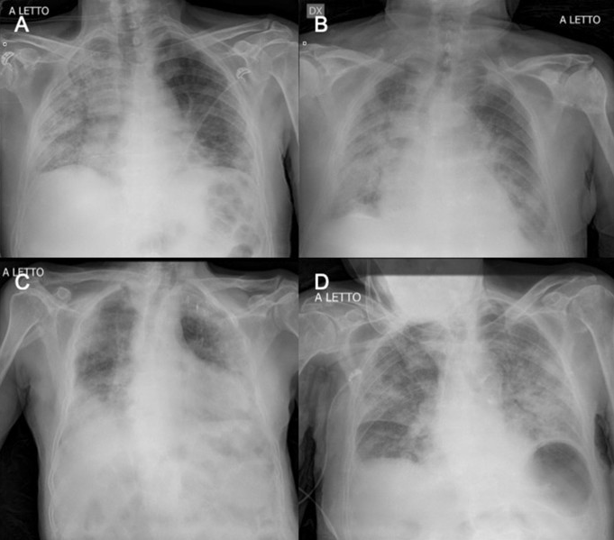RadiolMed's tweet photo. The most-cited 2020 papers of @RadiolMed on @webofscience and @Scopus:
Sixth position in the ranking:Chest Radiology/
Chest X-ray in new COVID-19 infection: findings and correlation with clinical outcome
https://t.co/3BD3eVjPzx
#Covid #radiology @ClinMedJournals @mielesirm https://t.co/YrbA6X8E9p