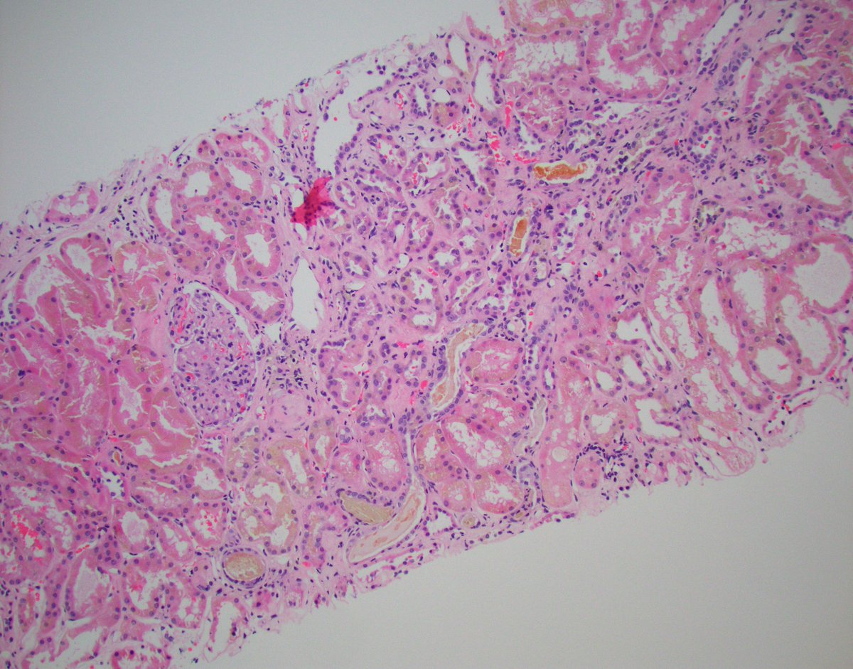 JZRenalPath's tweet photo. Case of bile cast nephropathy in a patient with biliary stricture and acute kidney injury. Many green brown bile casts associated with diffuse tubular injury. Also green/brown cytoplasmic granules in proximal tubules.  #renalpath https://t.co/7gVczfC6hW