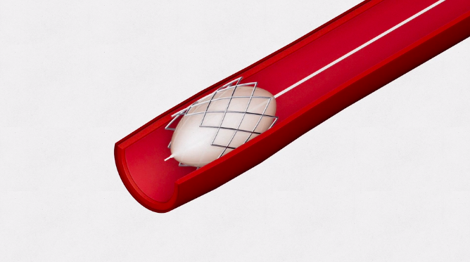 ExplainMy's tweet image. Coronary angioplasty is a technique used to treat narrowing of the arteries of the heart. 
.
Visit our website to watch our animation explainmyprocedure.com/demo-angioplas… 
.
Other procedures can be found here: explainmyprocedure.com
.
.
 #cardiology #stent #angiography #angioplasty #balloon