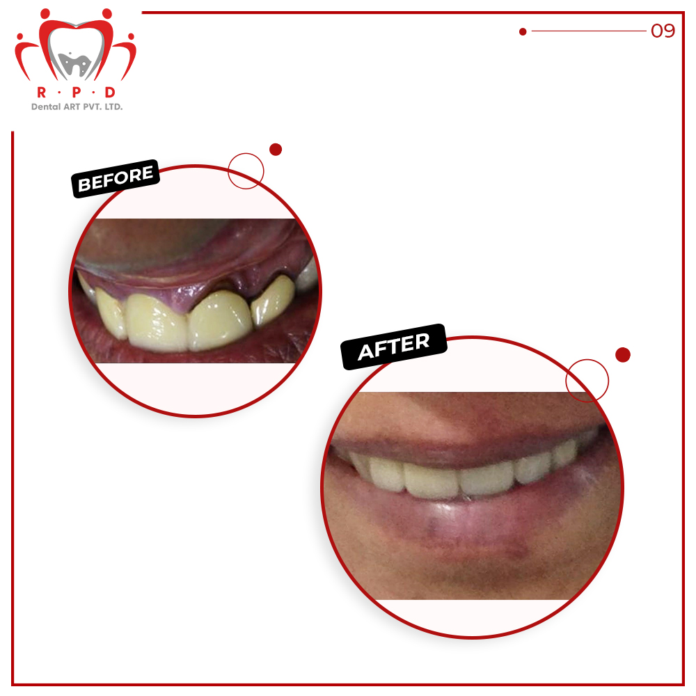 RPDDENTALART's tweet photo. ...(3)

#RPDDentalArt #ClientSmiles #Before #After #BeforeAfter #SmileMakeover #SmileMore #SmileDesign #NaturalLookingTeeth #TeethSmile #CosmeticDentistry #AestheticDentistry #DentalProducts #DentalSupplier #DentalLab #DentalLaboratory #DentalSmileDesign #DentalCrown #India https://t.co/9sS3dFBiuH