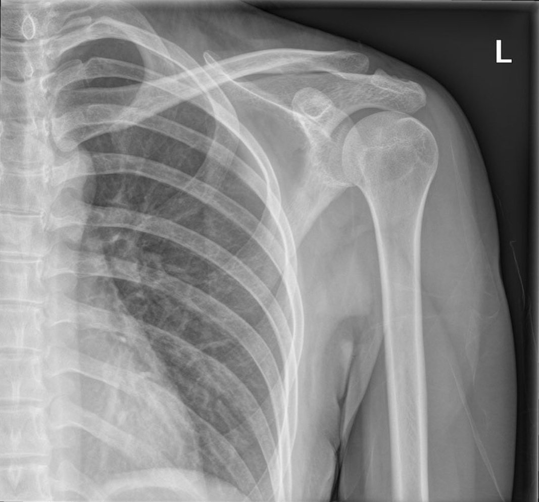 X ray shoulder. Shoulder xray. Shoulder rotation. деформирующий артроз плечевого сустава рентген. плечевой сустав норма.