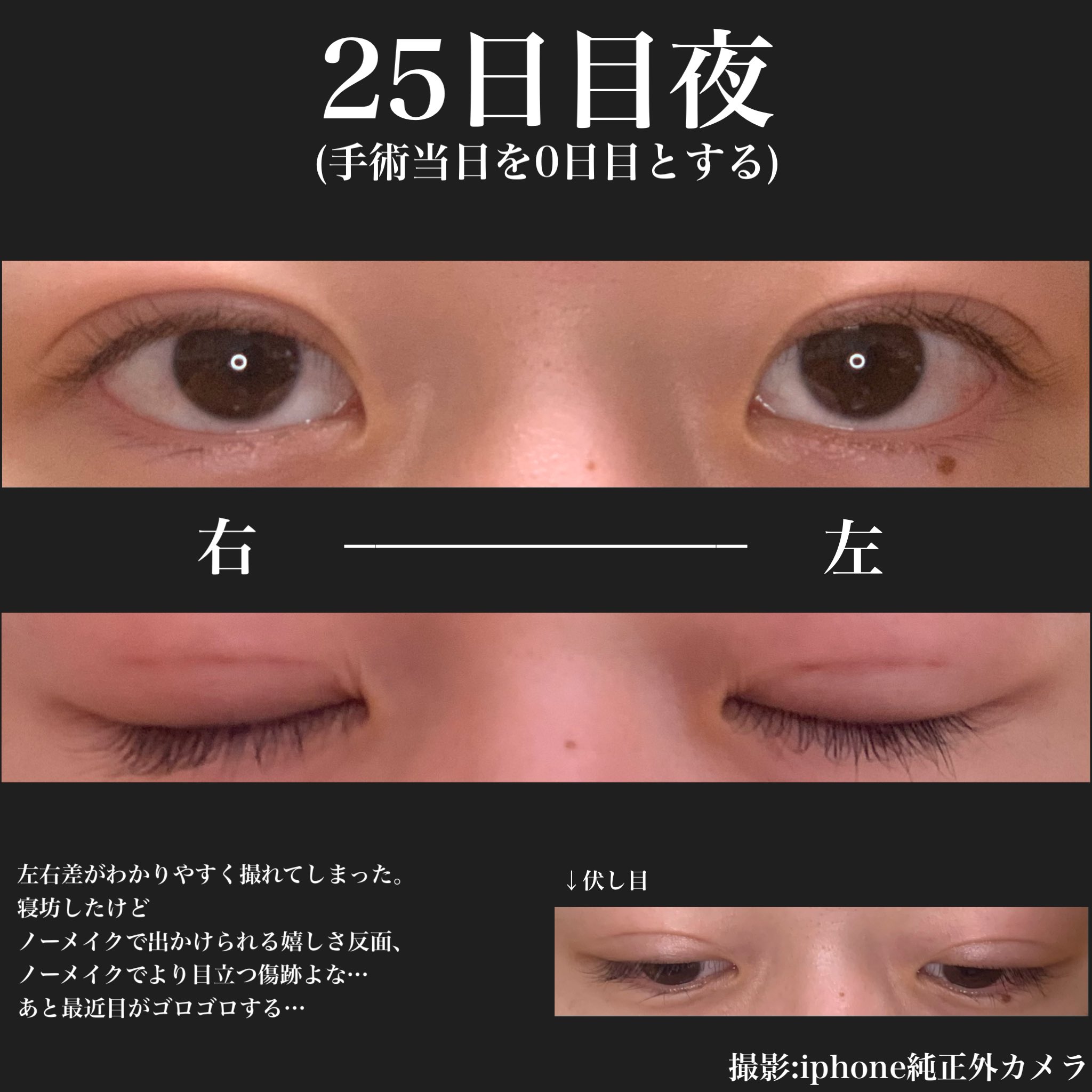 Rei 二重埋没 経過日記 25日目 顔面の問題 骨格とか 筋肉とかの左右差 も関わってくるんだろうけど やっぱり左右差が気になってしまう 二重幅他人に指摘されてから色んなこと気になりすぎてるよくない 二重埋没 水の森 T Co Pzdcjsx3lg