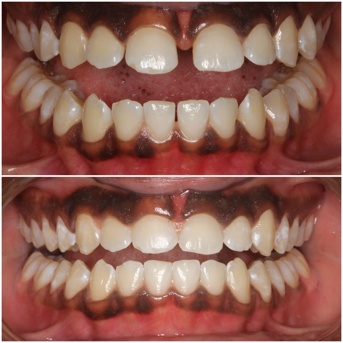 DMDGroup's tweet photo. #Invisalign #CosmeticDentist #SmileMakeover #Platinumprovider #DublinMetroDental #CelebrityDentist #DMD #DMDTeam #DMDSmiles #DMDOffers #DMDpatients https://t.co/lHtvAiZXV5