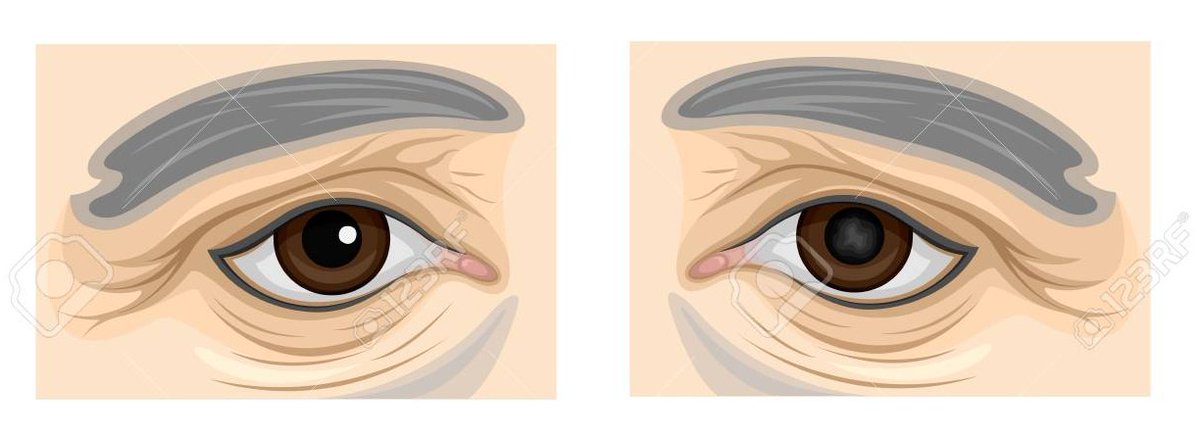 B1B2B3_'s tweet photo. #SabiesQue La #cataracta és la primera causa mundial de discapacitat visual? Afecta al 50% de les persones de més de 65 anys i moltes vegades es diagnostica al naixement. https://t.co/Qebd89ZPvX
