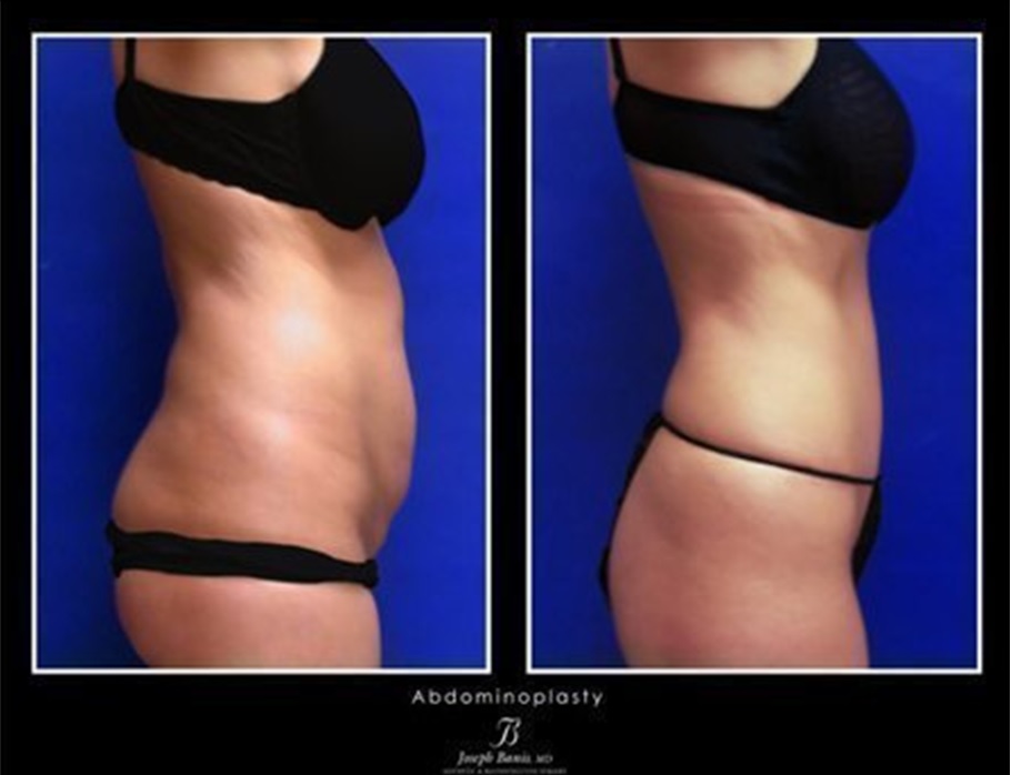 DrJosephBanis's tweet photo. A tummy tuck removes excess fat and skin and, in most cases, restores weakened or separated muscles creating an abdominal profile that is smoother and firmer. Learn more here: https://t.co/KVi3jbySul https://t.co/dD7ChgjfQn
