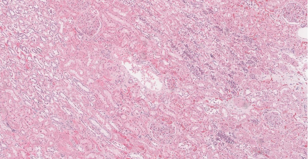 TimBell_Path's tweet photo. When evaluating a kidney biopsy, cells of the proximal tubules appear eosinophilic and granular (due to the high mitochondrial content, lots of energy being used for transport!).  The distal tubules have a flatter appearance with less cytoplasm @KMirza #TwitterHomework https://t.co/rqdan6RnS4