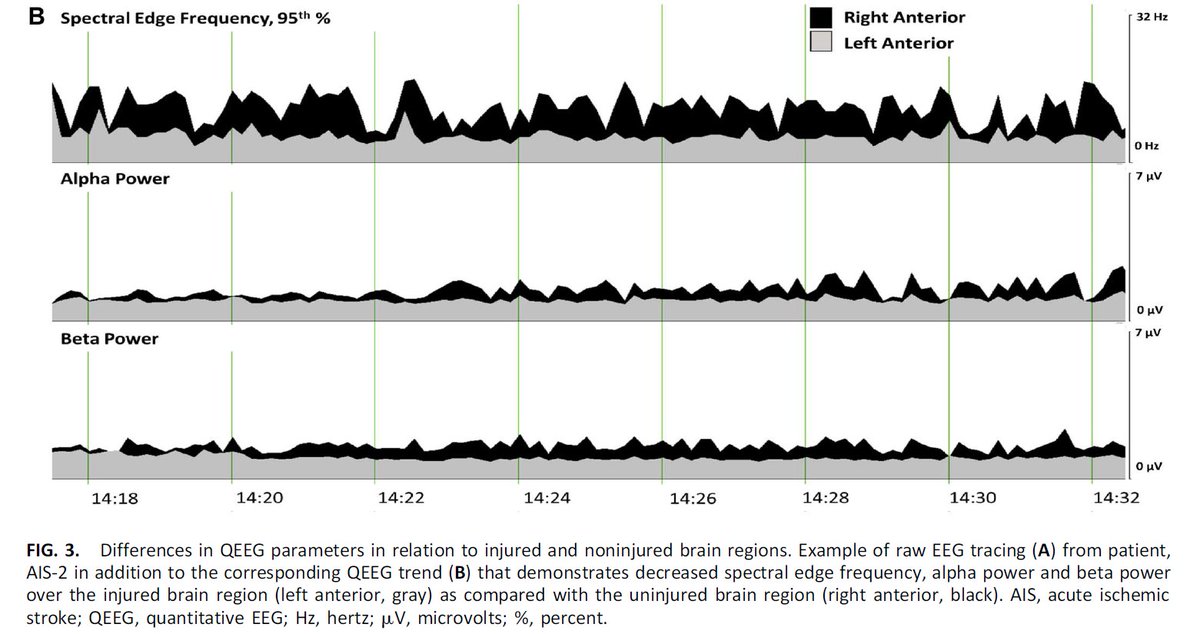 JClinNeurophys's tweet photo. Quantitative Electroencephalography After Pediatric Anterior Circulation Stroke - https://t.co/uDN2HDj0Gc Check out this work by @bappavu &amp; team from @BarrowNeuro @PhxChildrens @ACNS_org #QEEG @AANMember @PNCRGtweets https://t.co/gNYdk9ecjx