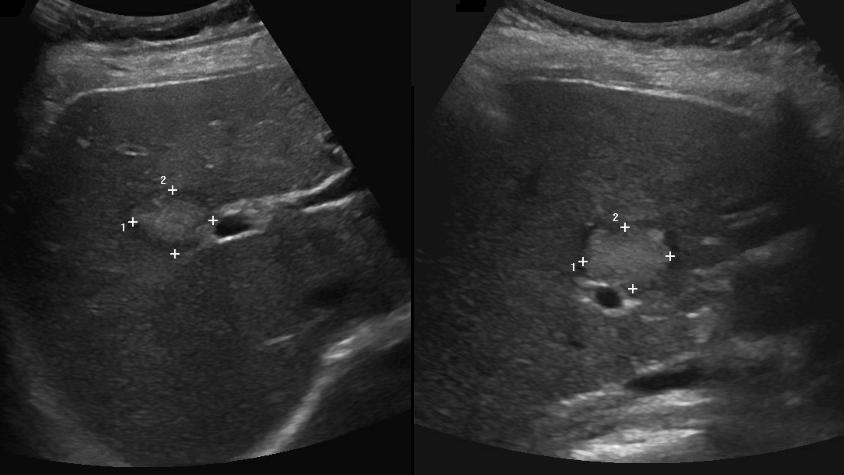 DrNeilGuptaIR's tweet photo. Wonderful start to 2021 doing an intraoperative #IRE case @nhsuhcw 
Nanoknife uses electrical current to produce nanopores in tumour cell membranes which disrupts homeostasis &amp; causes apoptosis of tumour cells, sparing vessels, nerves &amp; ducts!#itslikesurgeryonlymagic https://t.co/1tKR1gMgbo