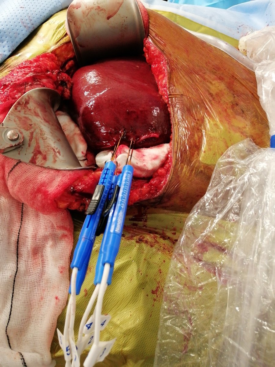DrNeilGuptaIR's tweet photo. Wonderful start to 2021 doing an intraoperative #IRE case @nhsuhcw 
Nanoknife uses electrical current to produce nanopores in tumour cell membranes which disrupts homeostasis &amp; causes apoptosis of tumour cells, sparing vessels, nerves &amp; ducts!#itslikesurgeryonlymagic https://t.co/1tKR1gMgbo