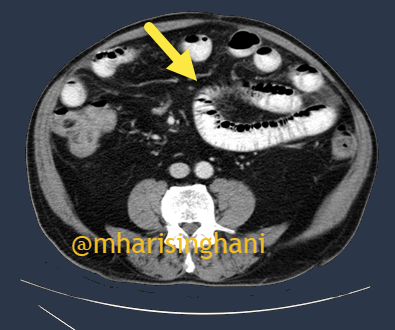 mharisinghani's tweet photo. This patient needs to be taken to OR; closed loop obstruction due to adhesion; focal dilated loop with stranding at the point of twist https://t.co/y0KOKSTPOq