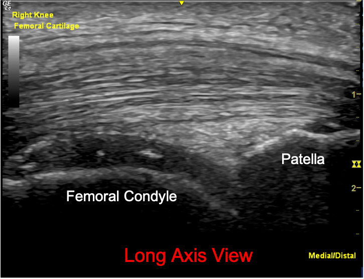 What condition can this type of deposition occur in the distal femoral hyaline cartilage?
A) Gout
B) Pseudogout
C) Osteoarthritis
D) None of the above