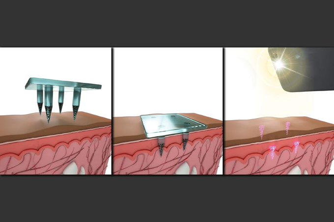 julija9j's tweet photo. 👇British Scientists Developing World’s First Covid-19 
    Vaccine Smart Patch

Storing medical information below the skin’s surface

"Microneedle patches, could be used to deliver nanoparticles when pressed to the skin. Like QR codes, could be scanned&amp;interpreted by smartphones https://t.co/YLb8KA6WOZ